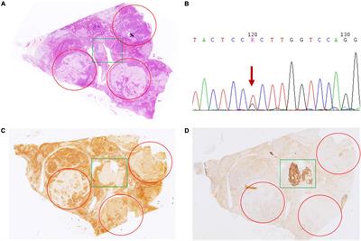 Exploration of KCNJ5 Somatic Mutation and CYP11B1/CYP11B2 Staining in Multiple Nodules in Primary Aldosteronism